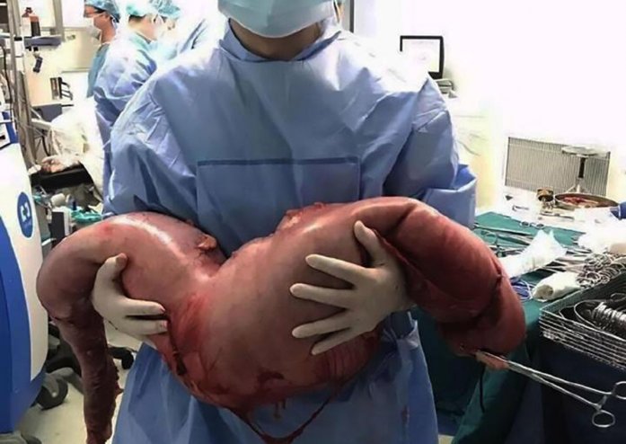 Китайские врачи удалили из живота пациента гигантскую аномалию