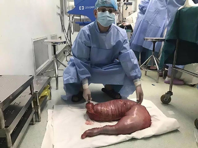 Китайские врачи удалили из живота пациента гигантскую аномалию