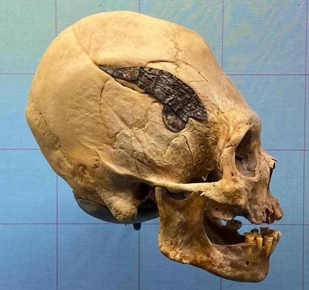 Удлиненный череп с имплантированным куском металла является доказательством передовой хирургии древних