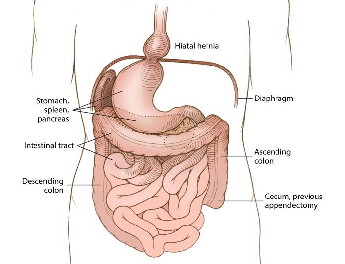 внутрение органы, транспозиция внутренних органов, кишечник, печень