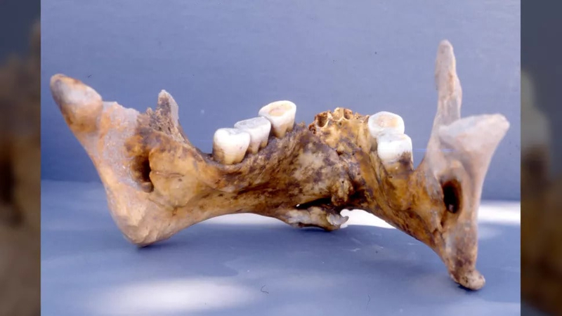 Нижняя челюсть воина со следами заросшего перелома