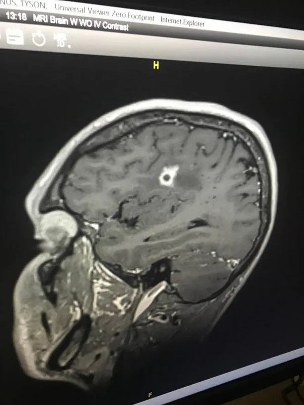 Первая МРТ мозга Боттенуса, сделанная в марте 2018 года