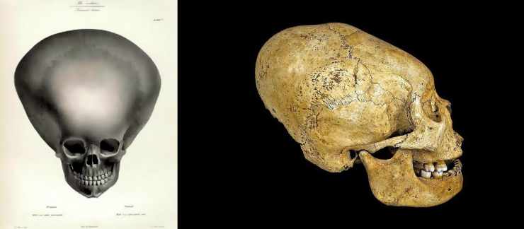 Homo capensis. Деформация черепа Гунны.