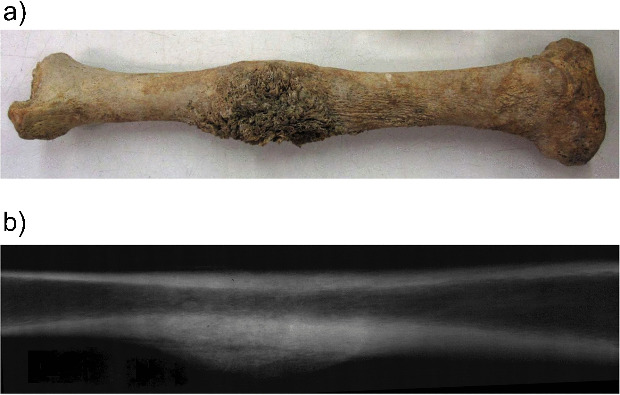 Фотография и рентгенограмма правой большеберцовой кости с поражениями